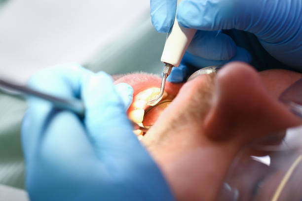 Best Broken or Chipped Tooth Repair in University Of Lifornia Santa Barbara, CA